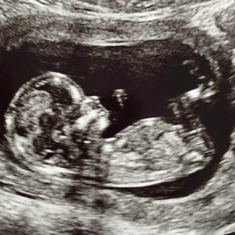 Early pregnancy ultrasound image