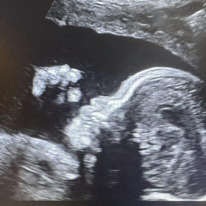 An early ultrasound (2D) image of a baby